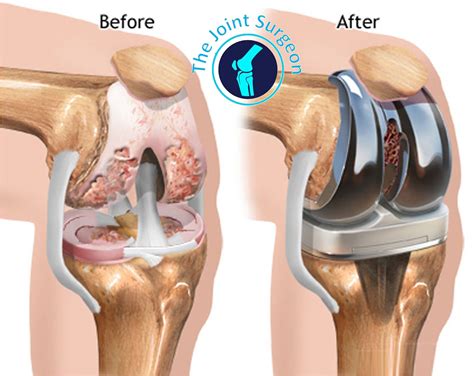 Fast Track Total Knee Replacement Surgery Welcome To The Joint Surgeon Indore