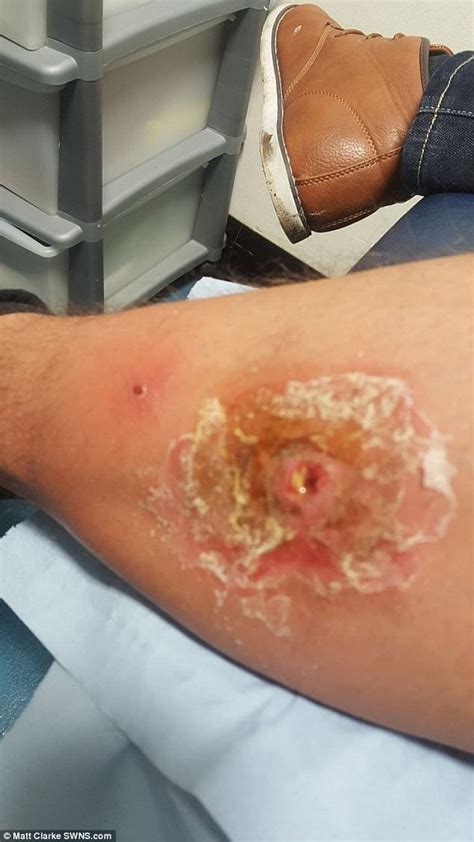 Man Left With Huge Hole In Leg After Spider Bite Photos