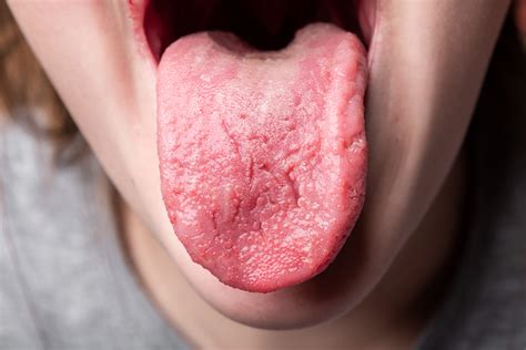 The reports initially came from england where tim spector, a researcher at king's college london, was. Tongue Disease: Health Clues Hiding on Your Tongue | The ...