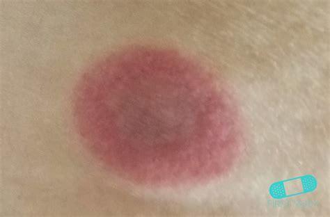 Online Dermatology Erythema Multiforme