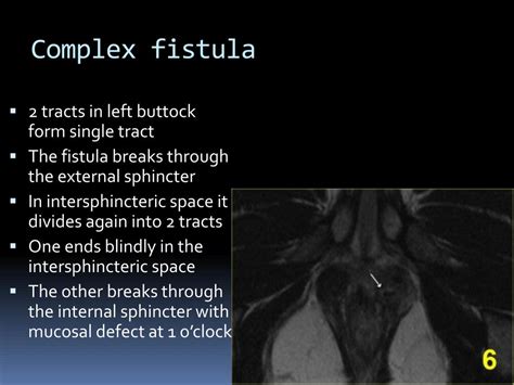 ppt mri imaging of perianal fistula powerpoint presentation free download id 2986971