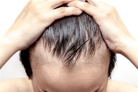 Top 5 Signs Of Early Balding And What To Do About It Fashionwindows