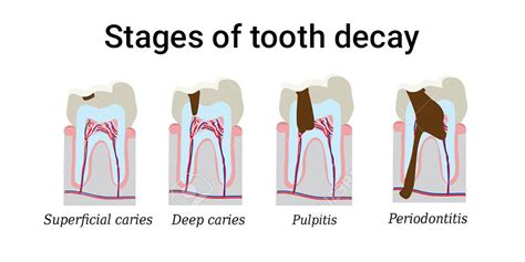 The 5 Stages Of Tooth Decay And What Can Be Done To Prevent
