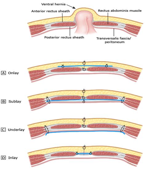 Umbilical Hernia General Bariatric Surgery Of South Florida Dr Alvaro Garcia