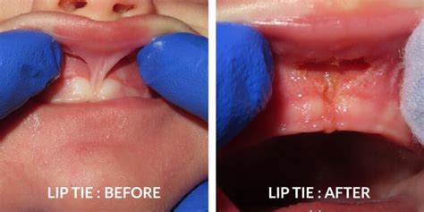 Lip And Tongue Ties Advanced Pediatric Dentistry