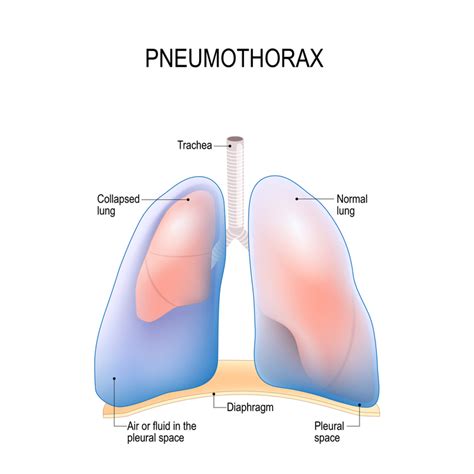 Pneumothorax And Hemothorax Hemothorax And Pneumothorax Nursing