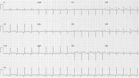Accelerated Junctional Rhythm Ajr Litfl Ecg Library Diagnosis