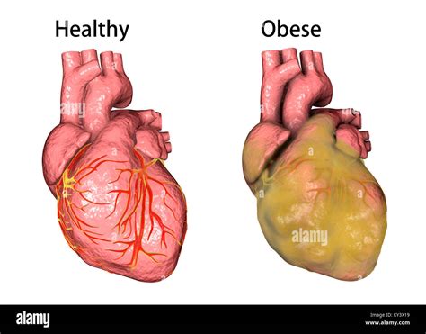 Corazón Obeso Fotos E Imágenes De Stock Alamy
