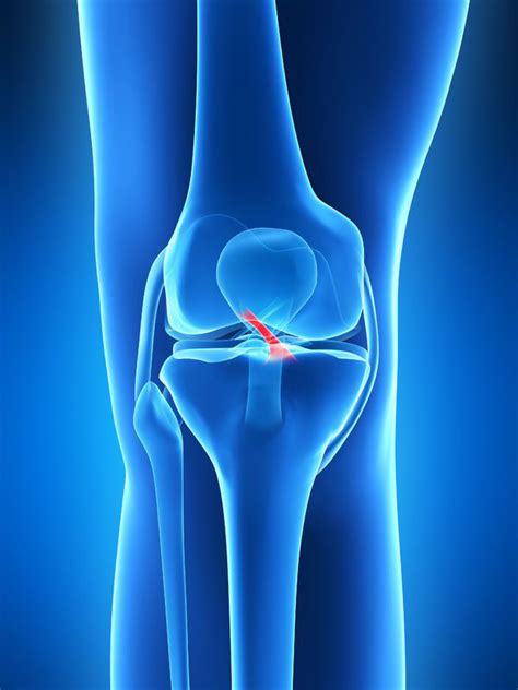 Tendon debridement and repair is most effective when less than 50% of the tendon is torn. ACL Injury :: South Arkansas Orthopaedics & Sports Medicine