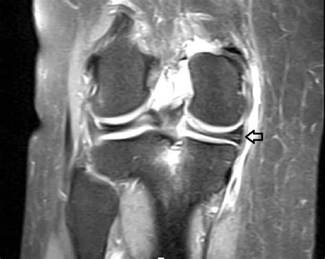 OrthoDx Meniscal Root Tear Clinical Advisor