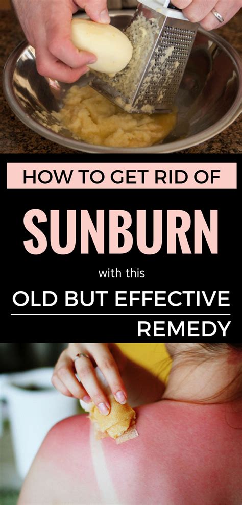 How To Get Rid Of Sunburn With This Old But Effective Remedy Get Rid