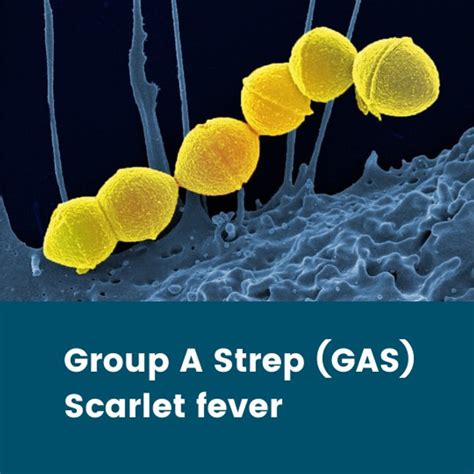 Group A Strep Scarlet Fever Information