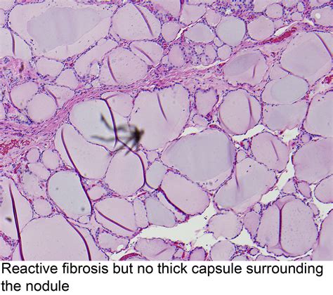 Pathology Outlines Thyroid Follicular Nodular Disease Multinodular