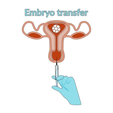 Fertilização Extracorpórea Em Estilo Plano E Desenhado à Mão Diagrama