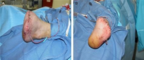 Squamous Cell Carcinoma Of The Foot Mimicking