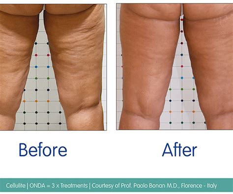 microwaves in the treatment of cellulite lynton lasers