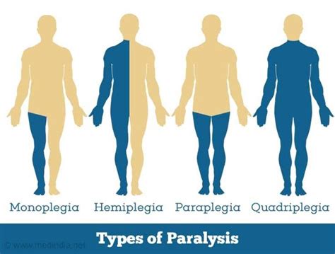 Way Does Paralysis Happen And To Whom It Happenes