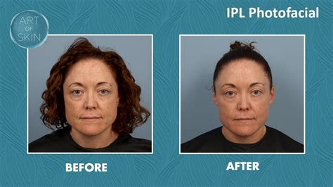 Ipl Photofacial For Face Rejuvenation Youtube