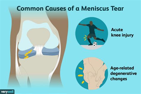 Meniscus Tears Symptoms Causes Diagnosis And Treatment