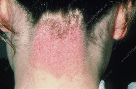 Eczema On The Back Of The Neck In A Girl Stock Image M1500111 Science Photo Library