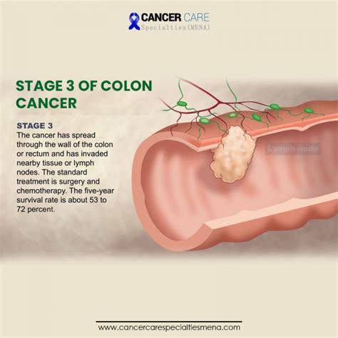 Stage 3 Of Colon Cancer Cancer Care Center Uae Cancer Treatment