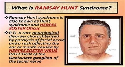 Download Free Medical Ramsay Hunt Syndrome Powerpoint Presentation