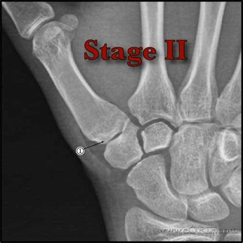 Thumb Basilar Joint Arthritis M19049 71514 Eorif