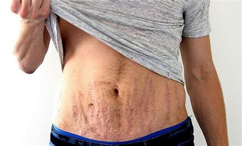 Steps To Help Men Get Rid Of Stretch Marks