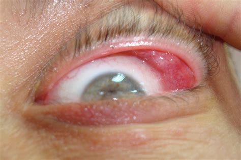 What is Sarcoidosis? Causes, Sign and symptoms — Your Daily Health Guide