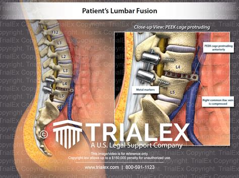 Lumbar Fusion Trialexhibits Inc