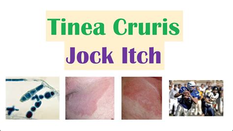 Jock Itch Tinea Cruris Causes Risk Factors Signs And Symptoms