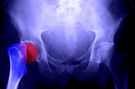 Es Un Avance Enorme Un Tratamiento Para Osteoporosis Que Reduce Las