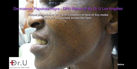 Video Dr U Rids Dpn Skin Tags On Face Los Angeles Ca