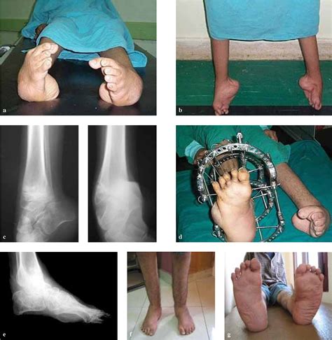 Figure 3 From Assessment Of Percutaneous V Osteotomy Of The Calcaneus