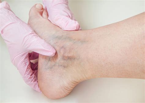 What Is Vein Disease 7 Facts You Have To Know About Vein Disease