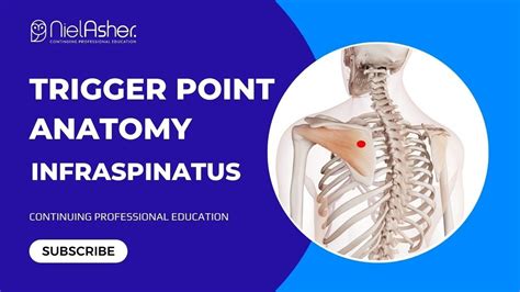Exploring The Infraspinatus Understanding Trigger Point Locations For