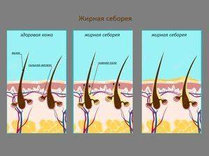 Диета при себорейном дерматите: питание при себорее головы и кожи лица Картинка - Диета при себорейном дерматите: питание при себорее головы и кожи лица