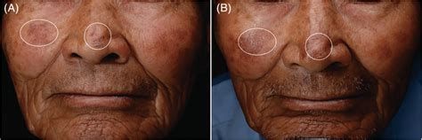 Multiple Actinic Keratosis On The Face Was Eradicated By Three Courses