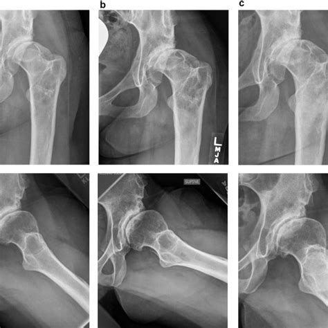 Serial Anteroposterior And Lateral Left Hip Radiographs Reveal