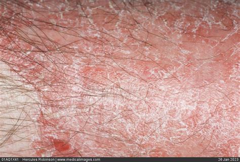 Stock Image Dermatology Psoriasis A Deep Pink Patch With Dry White