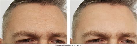 Woman Wrinkles Forehead Before After Procedures Stock Photo 1265535481