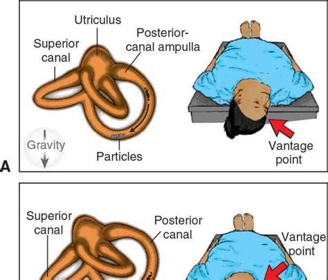 Eply Maneuver Epley Liberatory Manoeuvre For Bppv The