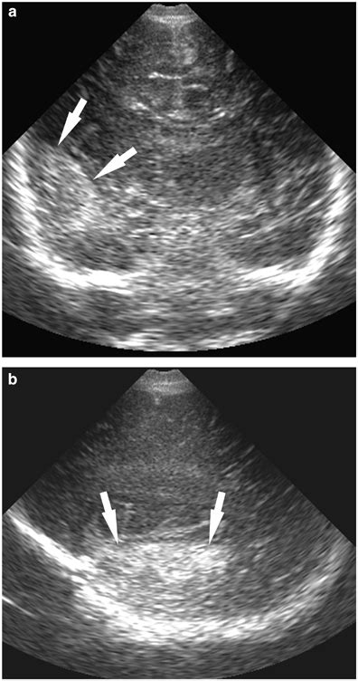 Ultrasound Coronal A And Sagittal B Sonographic Images Taken