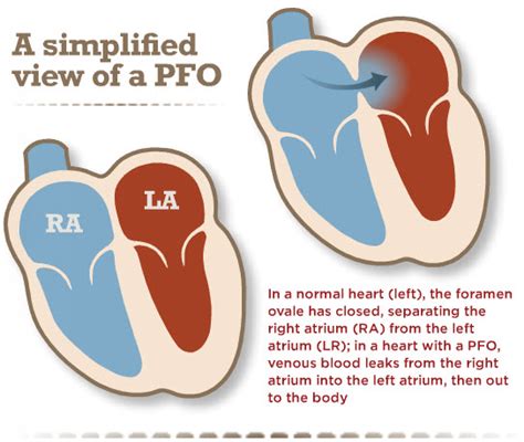 Understanding Patent Foramen Ovale Pfo And Its Implications