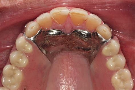 Removable Partial Dentures American College Of Prosthodontists