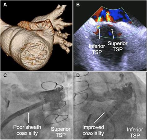 Performing Transcatheter Left Atrial Appendage Closure Techniques And