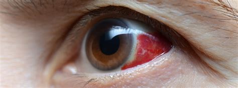 8 Common Causes Of An Eye Infection Hella Health