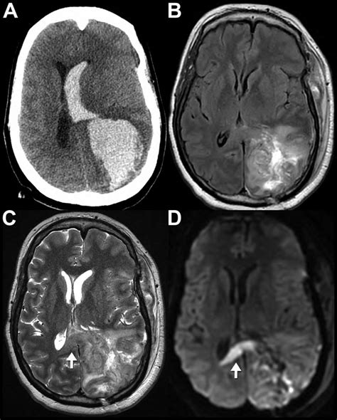 Ct And Mr Appearance Of Intracerebral Hematoma Download Scientific