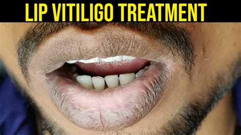 Lip Vitiligo Lip Vitiligo Treatment Lip Leucoderma Safed Daag Ka