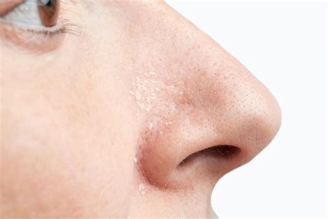 Psoriasis On The Nose Causes Treatment Prevention